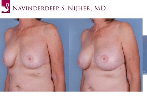 Breast Revisions Case #12241 (Image 2)