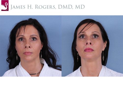 Facial Implants Case #31068 (Image 1)