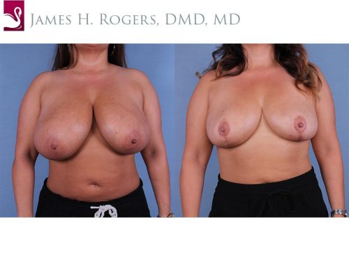 Female Breast Reduction Case #55476 (Image 1)