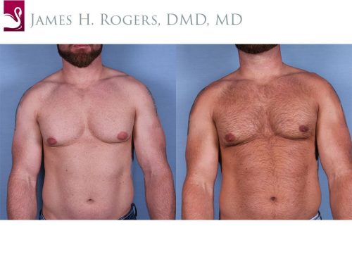 Male Breast Reduction Case #56146 (Image 1)