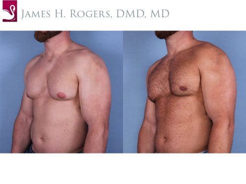 Male Breast Reduction Case #56146 (Image 2)