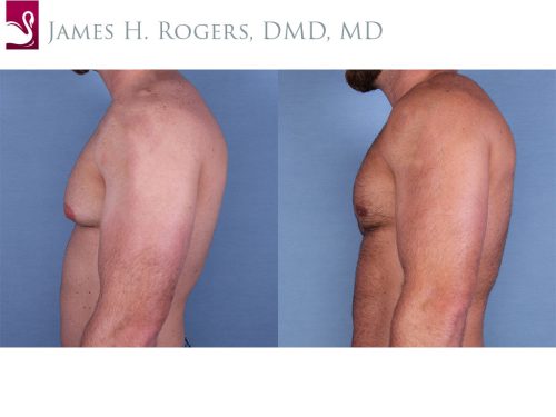 Male Breast Reduction Case #56146 (Image 3)