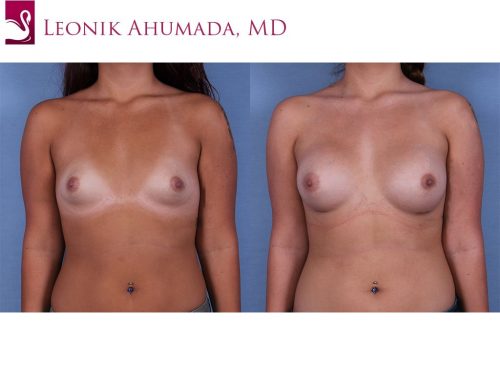 Breast Augmentation Case #60929 (Image 1)