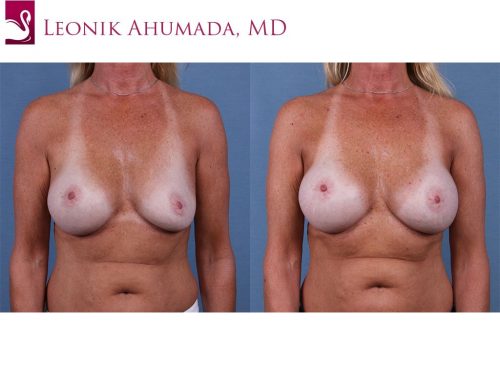 Breast Revisions Case #61348 (Image 1)