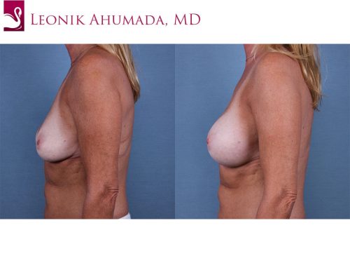 Breast Revisions Case #61348 (Image 3)