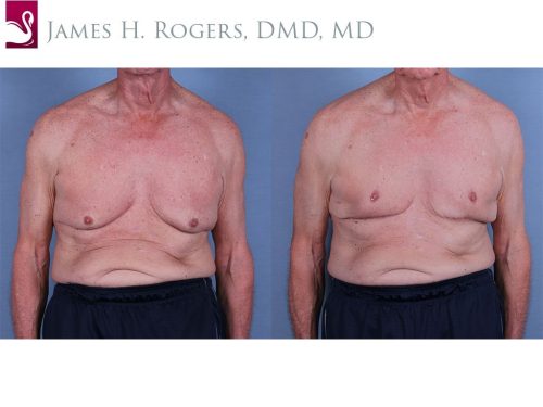 Male Breast Reduction Case #63133 (Image 1)
