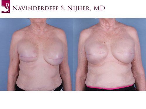 Breast Reconstruction Case #63344 (Image 1)