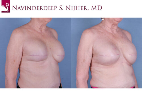Breast Reconstruction Case #63344 (Image 2)