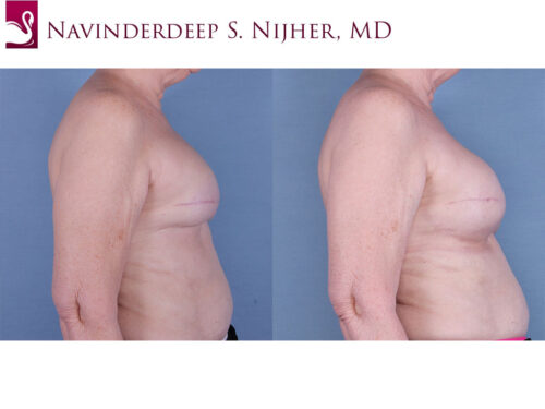 Breast Reconstruction Case #63344 (Image 3)