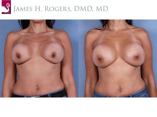 Breast Revisions Case #52842 (Image 1)