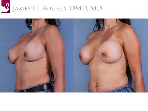 Breast Revisions Case #52842 (Image 2)