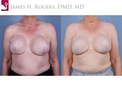 Breast Reconstruction Case #55453 (Image 1)