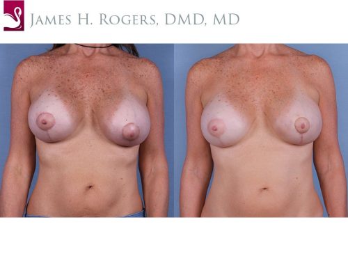 Breast Revisions Case #63179 (Image 1)