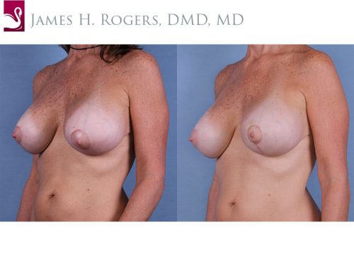 Breast Revisions Case #63179 (Image 2)