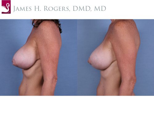 Breast Revisions Case #63179 (Image 3)