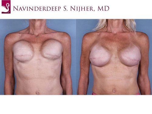 Breast Reconstruction Case #63952 (Image 1)