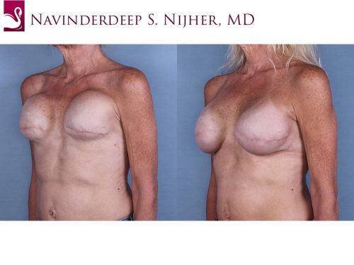 Breast Reconstruction Case #63952 (Image 2)