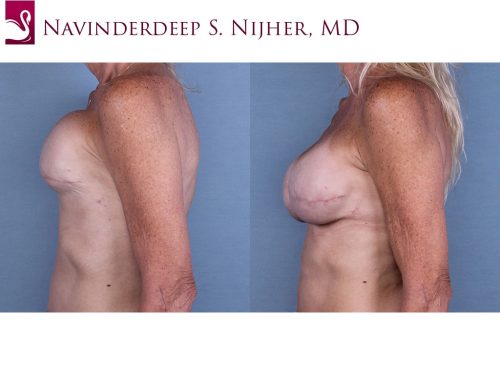 Breast Reconstruction Case #63952 (Image 3)