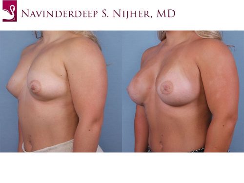 Breast Augmentation Case #64357 (Image 2)