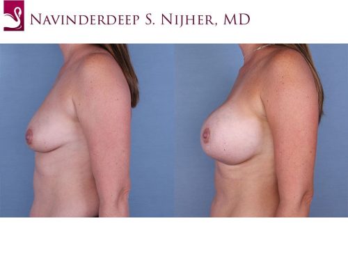 Breast Augmentation Case #64470 (Image 3)