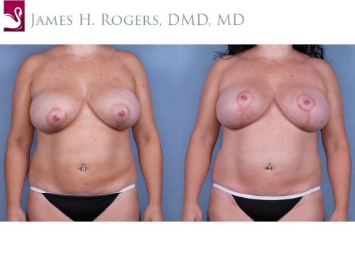 Breast Revisions Case #63337 (Image 1)