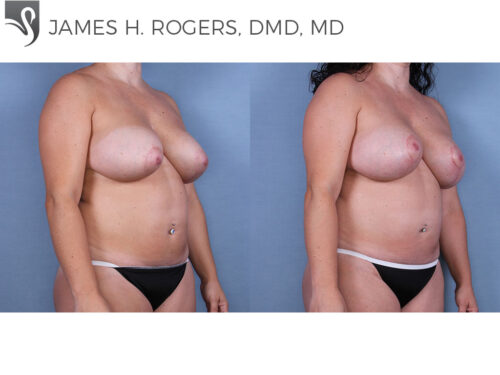 Breast Revisions Case #63337 (Image 2)