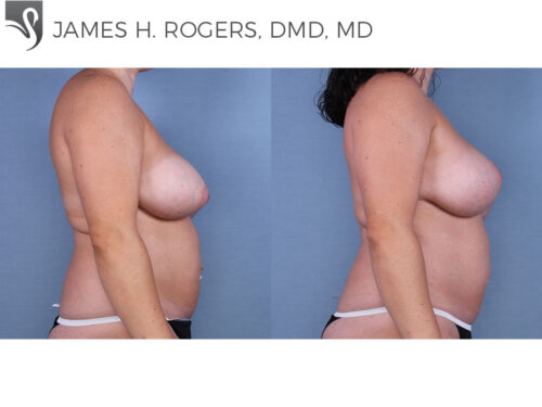 Breast Revisions Case #63337 (Image 3)