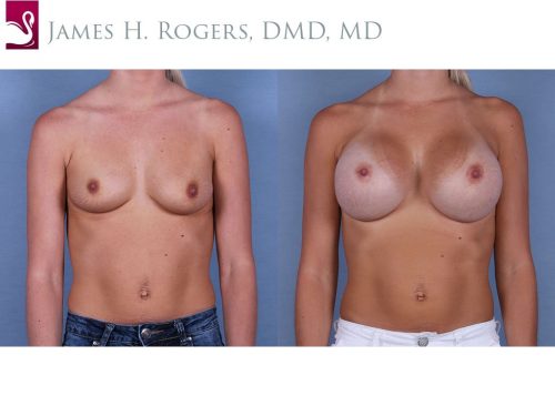 Breast Augmentation Case #64231 (Image 1)