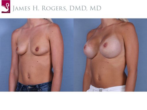 Breast Augmentation Case #64231 (Image 2)