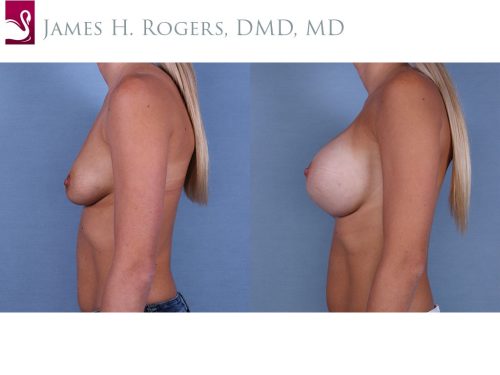 Breast Augmentation Case #64231 (Image 3)