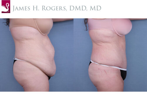 Abdominoplasty (Tummy Tuck) Case #64862 (Image 3)