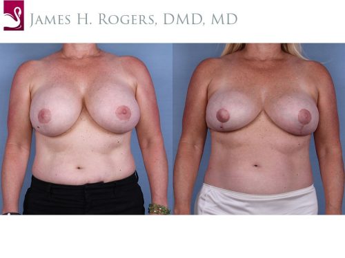 Breast Revisions Case #37642 (Image 1)