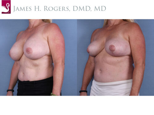 Breast Revisions Case #37642 (Image 2)