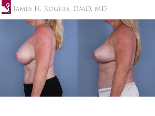 Breast Revisions Case #37642 (Image 3)