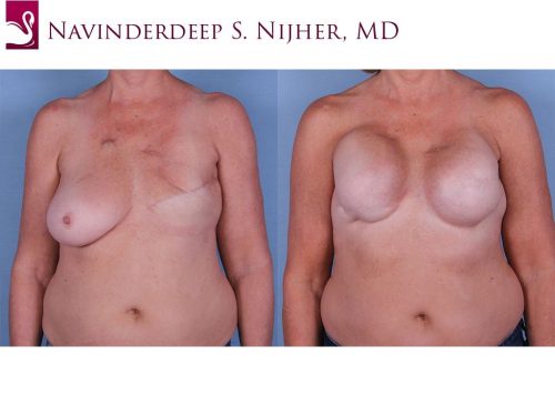 Breast Reconstruction Case #61908 (Image 1)