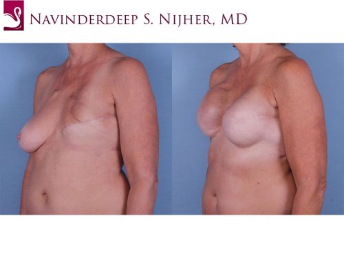 Breast Reconstruction Case #61908 (Image 2)