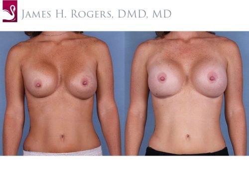 Breast Revisions Case #28791 (Image 1)