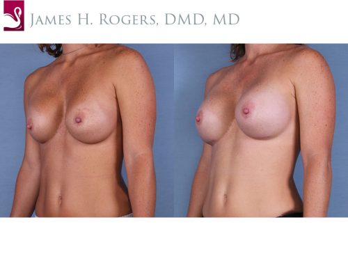 Breast Revisions Case #28791 (Image 2)