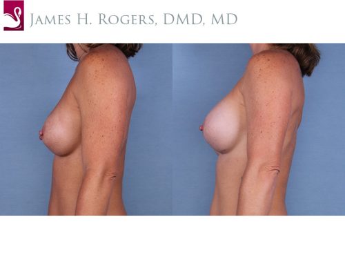 Breast Revisions Case #28791 (Image 3)