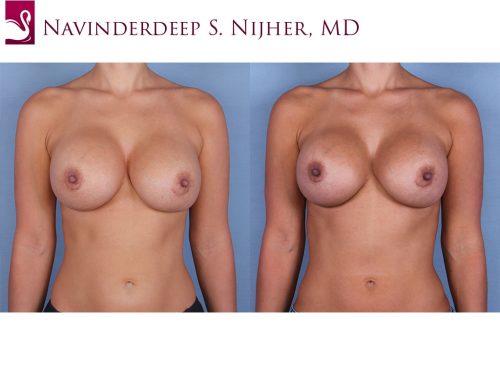 Breast Revisions Case #55230 (Image 1)