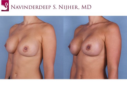 Breast Revisions Case #55230 (Image 2)