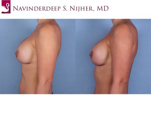 Breast Revisions Case #55230 (Image 3)