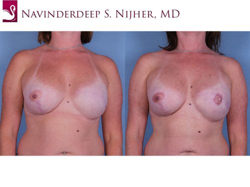 Breast Reconstruction Case #55317 (Image 1)