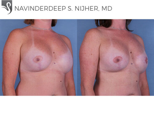 Breast Reconstruction Case #55317 (Image 2)