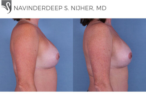 Breast Reconstruction Case #55317 (Image 3)