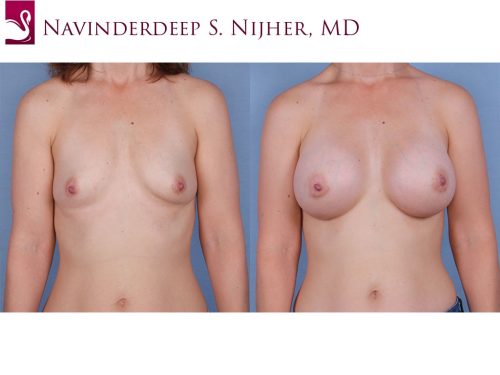 Breast Augmentation Case #62201 (Image 1)