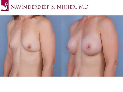Breast Augmentation Case #62201 (Image 2)