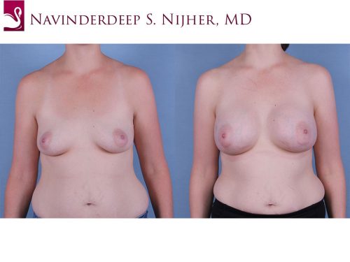 Breast Augmentation Case #63129 (Image 1)