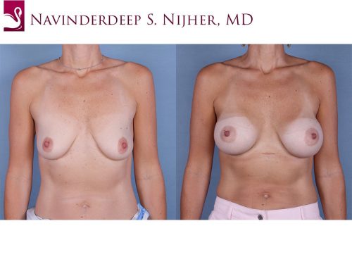Breast Augmentation Case #63491 (Image 1)