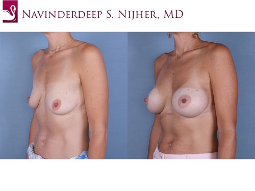 Breast Augmentation Case #63491 (Image 2)
